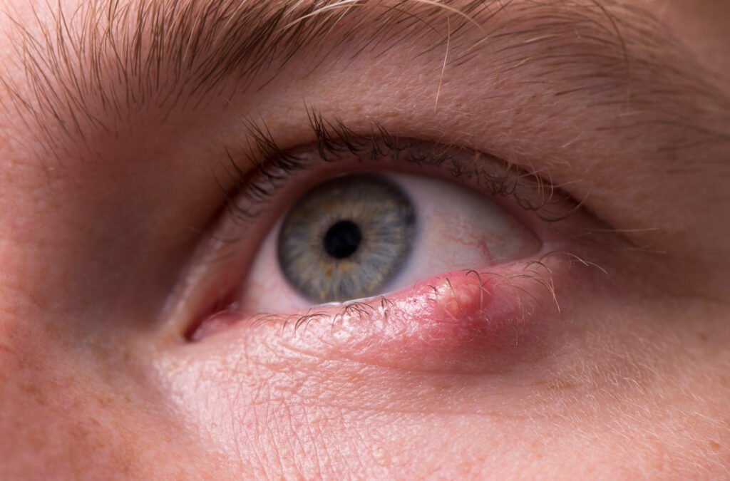 Does Hypochlorous Acid Really Help Clear a Stye Quickly?