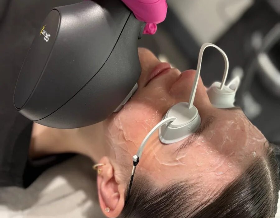 IPL skin rejuvenation